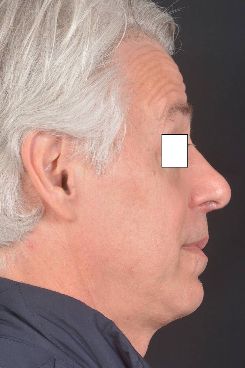 Rhinoplasty Before & After Gallery - Patient 135298 - Image 6