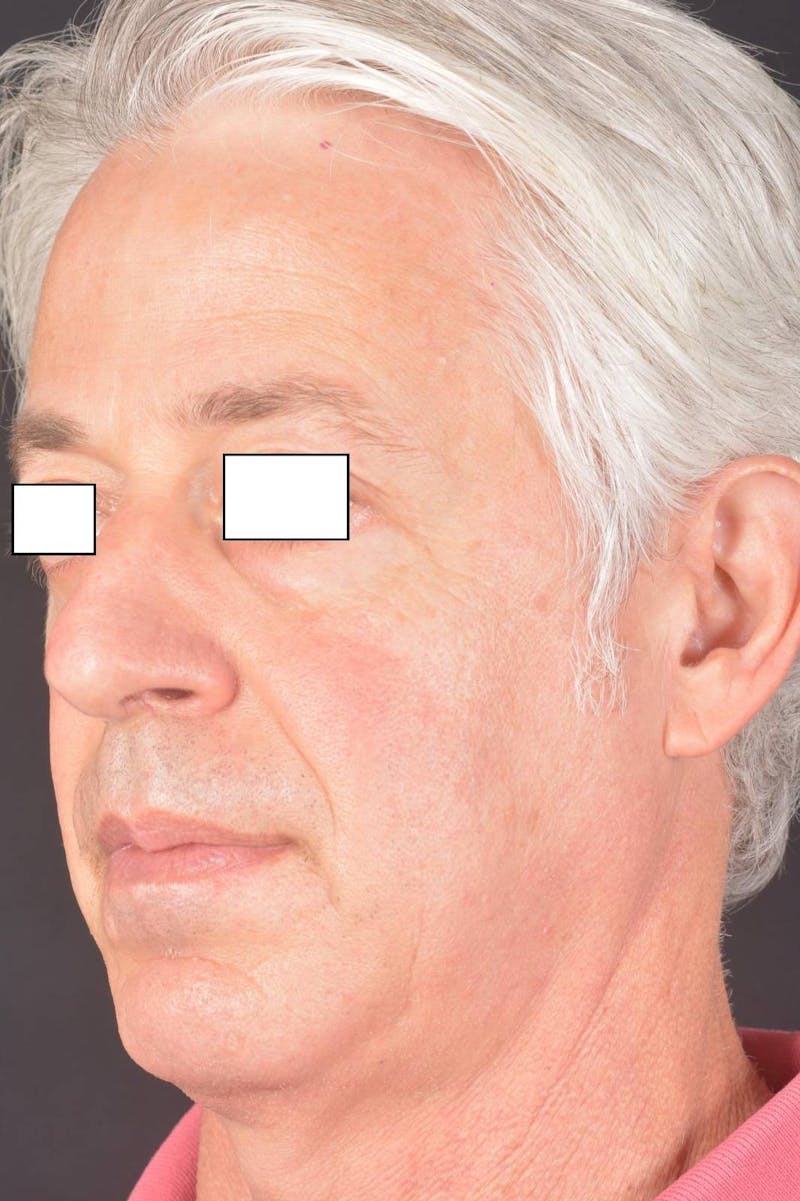 Rhinoplasty Before & After Gallery - Patient 135298 - Image 7