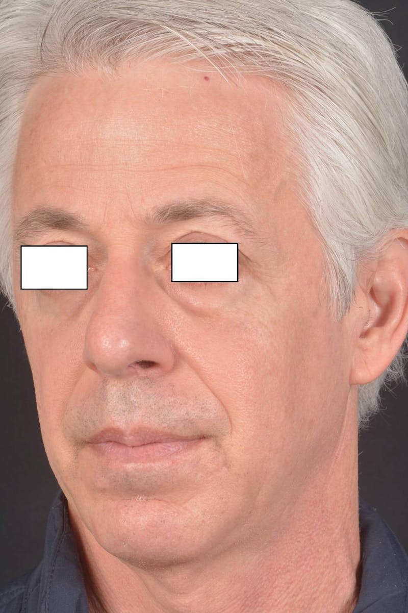 Rhinoplasty Before & After Gallery - Patient 135298 - Image 8