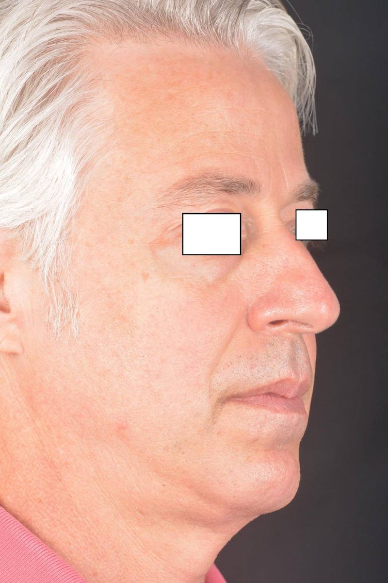 Rhinoplasty Before & After Gallery - Patient 135298 - Image 9