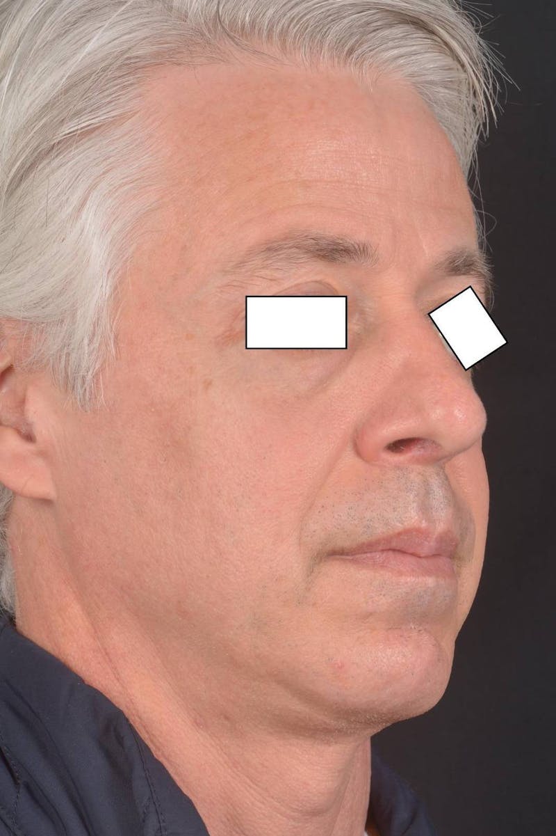 Rhinoplasty Before & After Gallery - Patient 135298 - Image 10