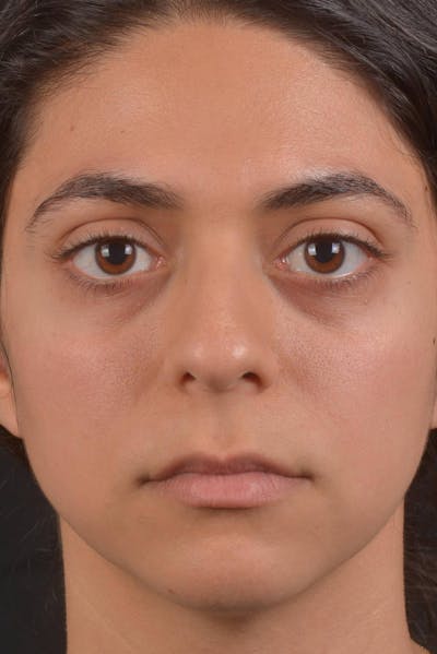 Rhinoplasty Before & After Gallery - Patient 397302 - Image 1