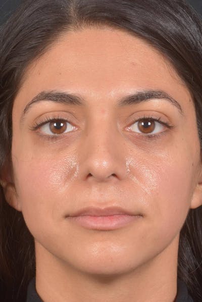 Rhinoplasty Before & After Gallery - Patient 397302 - Image 2