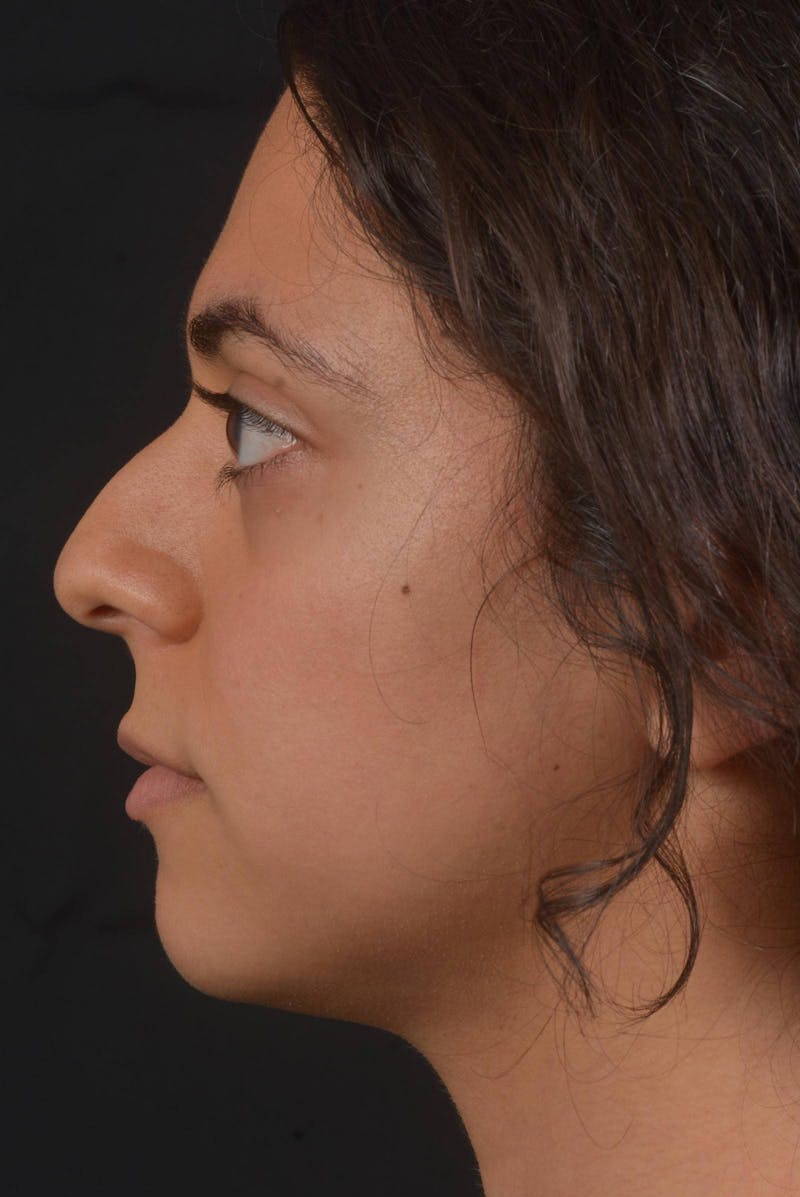 Rhinoplasty Before & After Gallery - Patient 397302 - Image 3