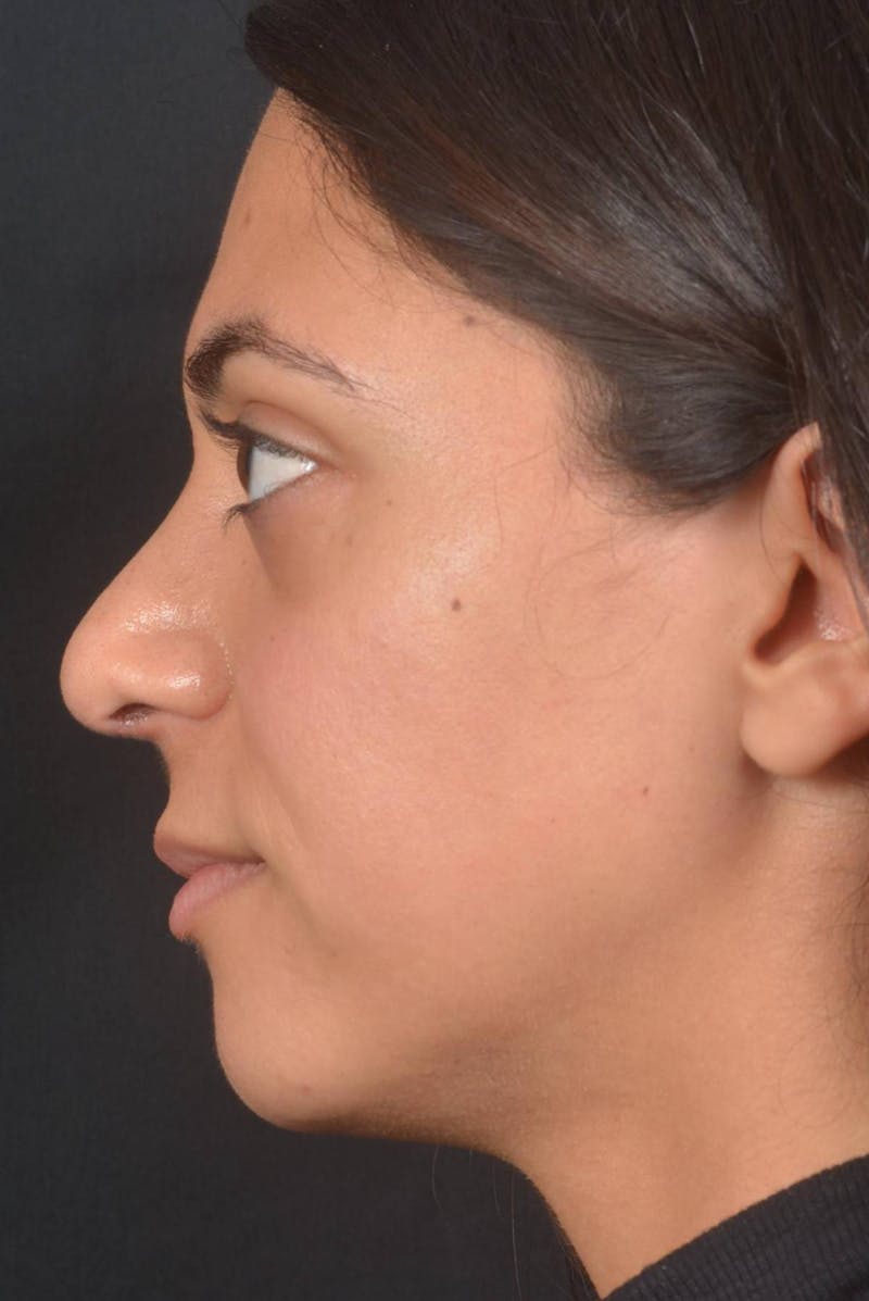 Rhinoplasty Before & After Gallery - Patient 397302 - Image 4