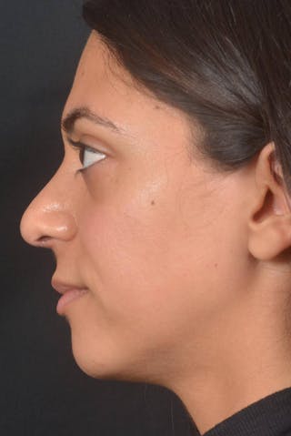 Rhinoplasty Before & After Gallery - Patient 397302 - Image 4