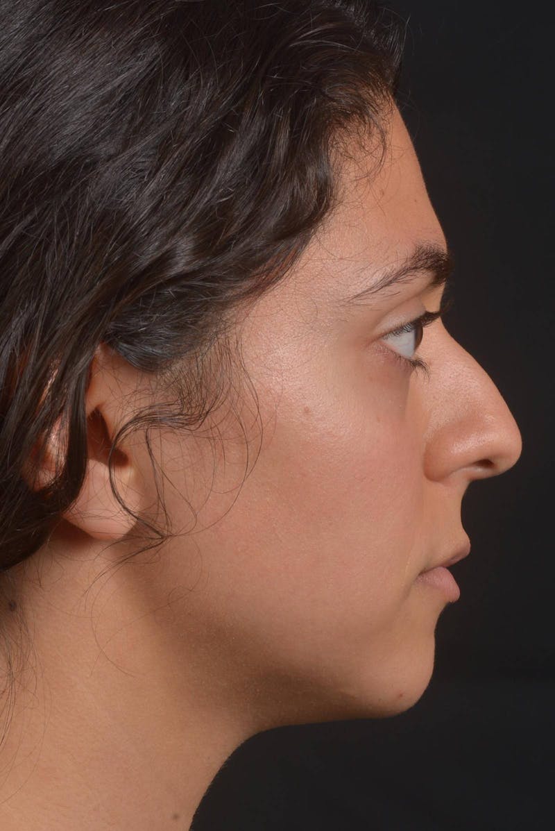 Rhinoplasty Before & After Gallery - Patient 397302 - Image 5