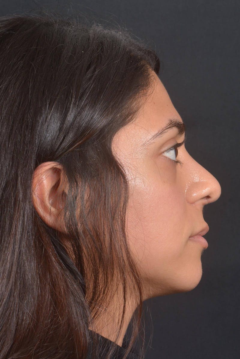 Rhinoplasty Before & After Gallery - Patient 397302 - Image 6