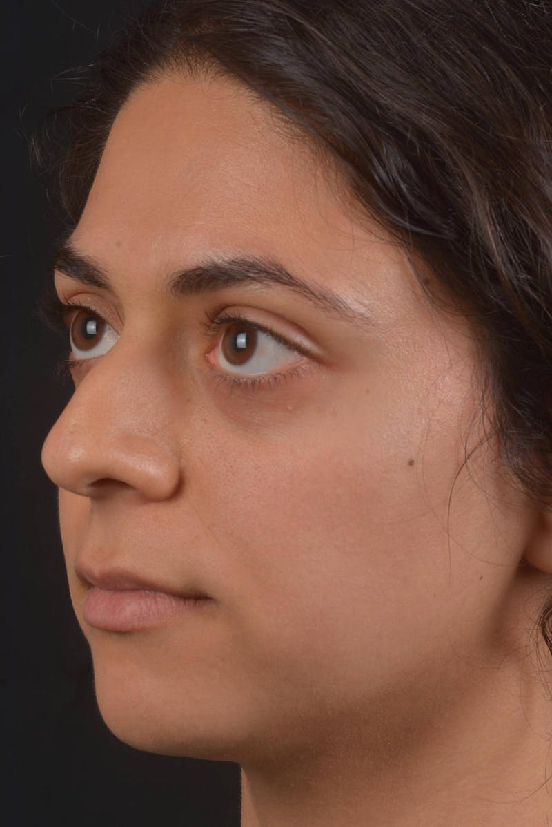 Rhinoplasty Before & After Gallery - Patient 397302 - Image 7