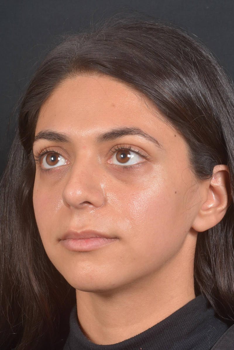 Rhinoplasty Before & After Gallery - Patient 397302 - Image 8