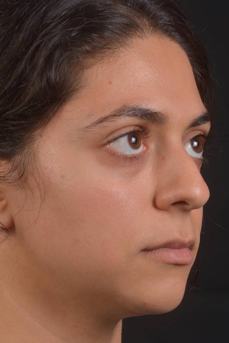 Rhinoplasty Before & After Gallery - Patient 397302 - Image 9
