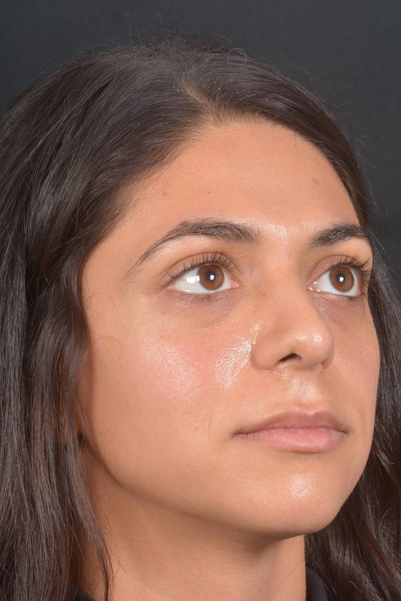 Rhinoplasty Before & After Gallery - Patient 397302 - Image 10
