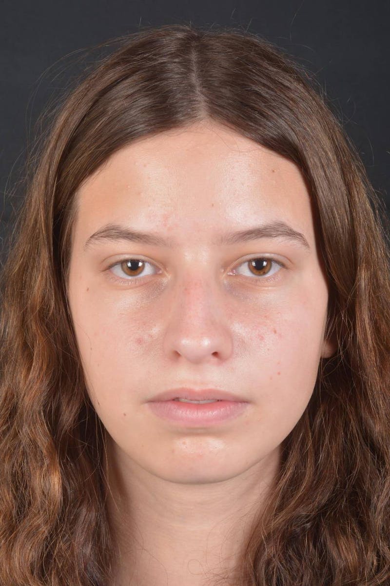 Rhinoplasty Before & After Gallery - Patient 327246 - Image 1
