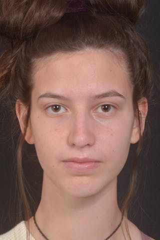 Rhinoplasty Before & After Gallery - Patient 327246 - Image 2