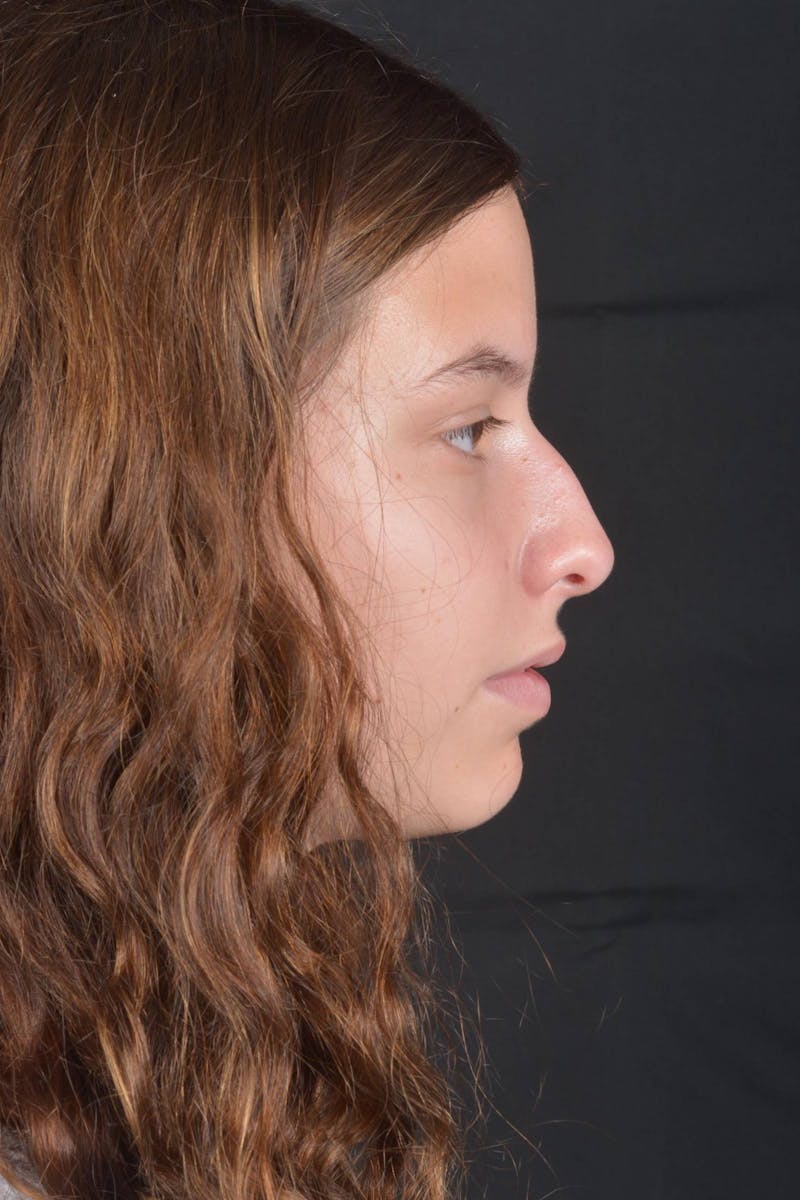 Rhinoplasty Before & After Gallery - Patient 327246 - Image 5