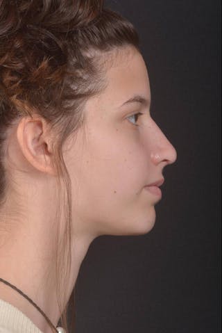 Rhinoplasty Before & After Gallery - Patient 327246 - Image 6