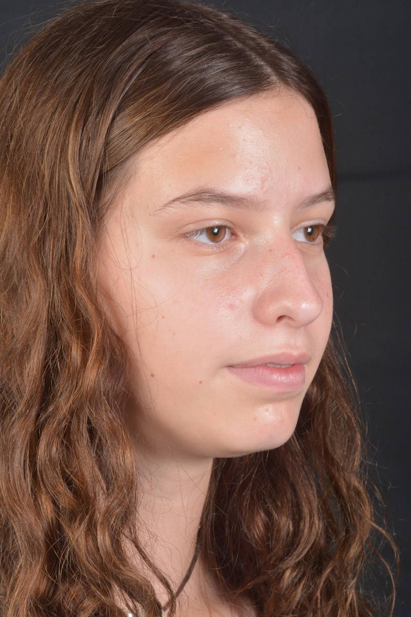 Rhinoplasty Before & After Gallery - Patient 327246 - Image 9