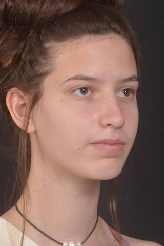 Rhinoplasty Before & After Gallery - Patient 327246 - Image 10