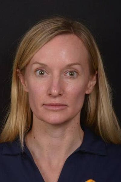 Rhinoplasty Before & After Gallery - Patient 383581 - Image 1