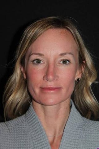 Rhinoplasty Before & After Gallery - Patient 383581 - Image 2