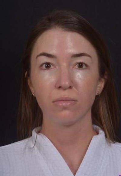 Rhinoplasty Before & After Gallery - Patient 281994 - Image 1