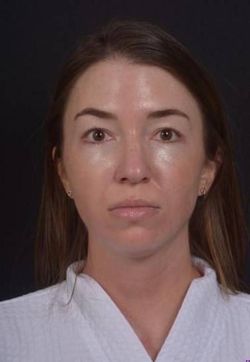 Rhinoplasty Before & After Gallery - Patient 281994 - Image 1