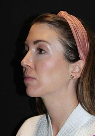 Rhinoplasty Before & After Gallery - Patient 281994 - Image 4