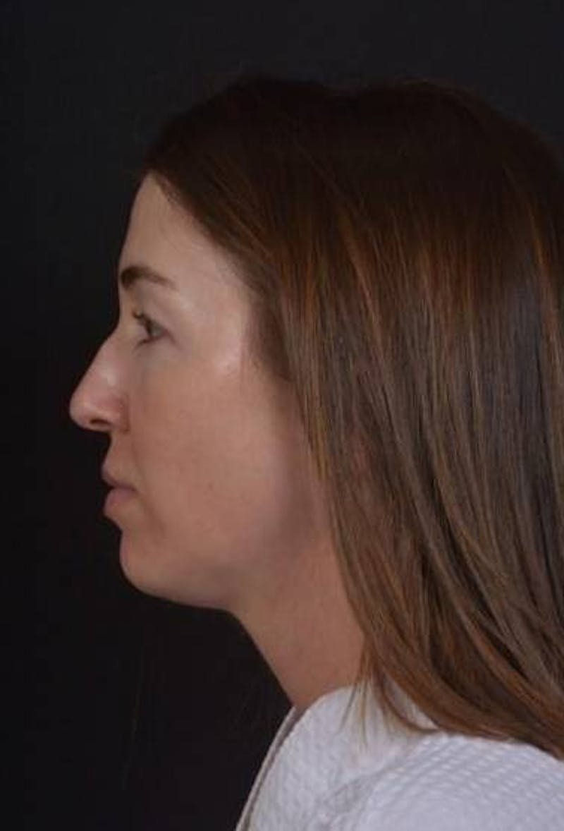 Rhinoplasty Before & After Gallery - Patient 281994 - Image 5