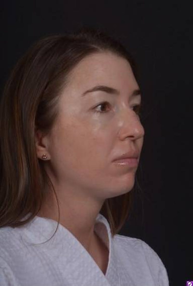Rhinoplasty Before & After Gallery - Patient 281994 - Image 7
