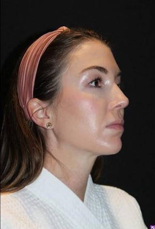 Rhinoplasty Before & After Gallery - Patient 281994 - Image 8