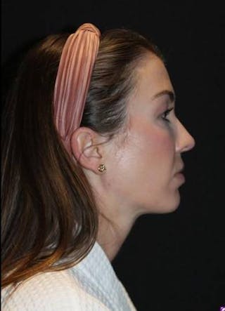 Rhinoplasty Before & After Gallery - Patient 281994 - Image 10