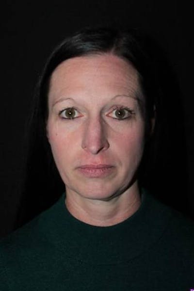 Rhinoplasty Before & After Gallery - Patient 408641 - Image 1