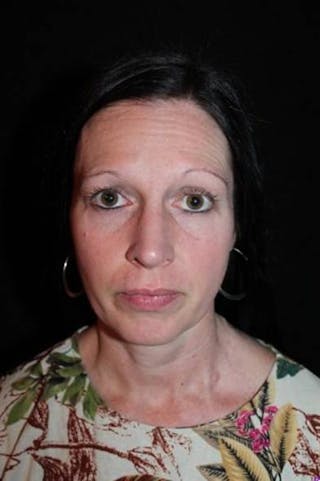 Rhinoplasty Before & After Gallery - Patient 408641 - Image 2