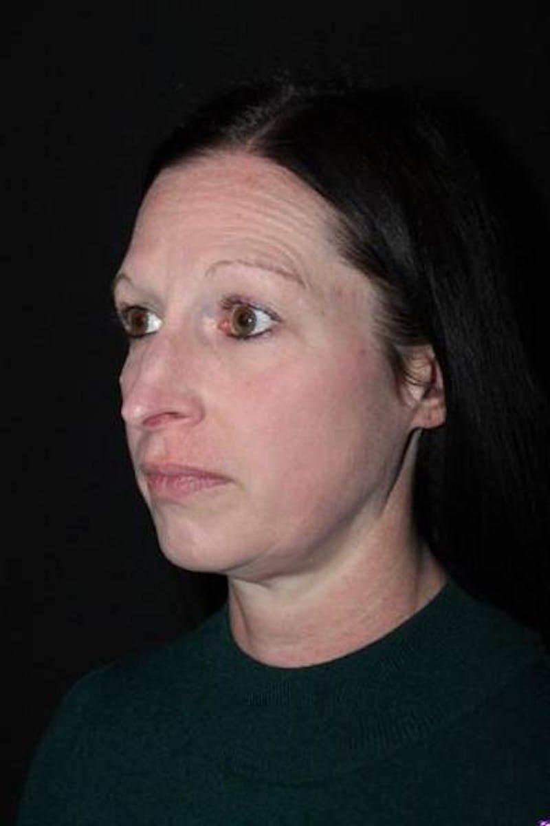 Rhinoplasty Before & After Gallery - Patient 408641 - Image 3