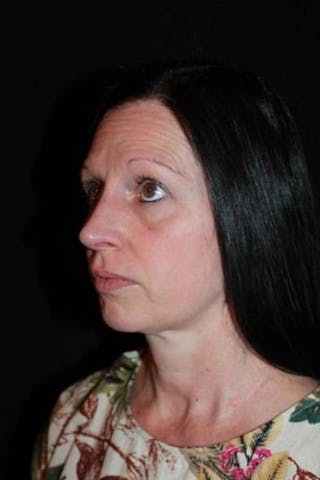 Rhinoplasty Before & After Gallery - Patient 408641 - Image 4