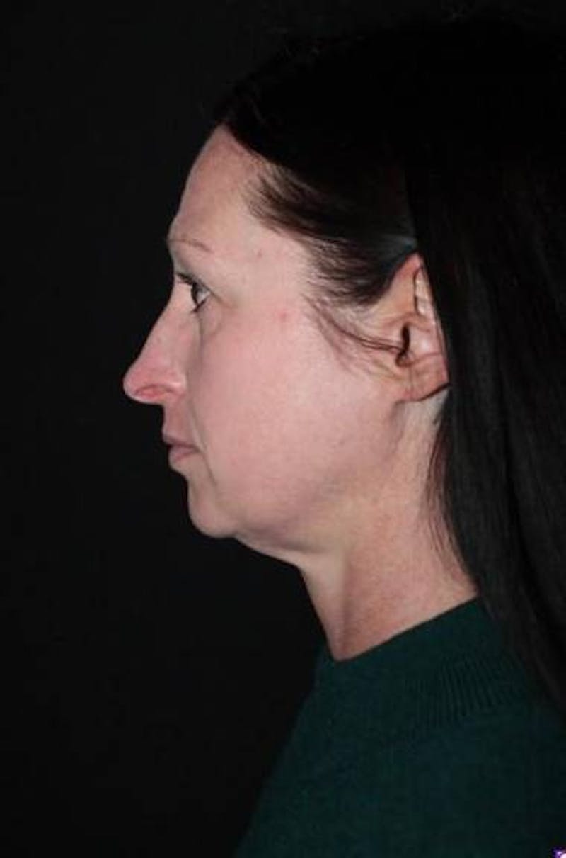 Rhinoplasty Before & After Gallery - Patient 408641 - Image 5