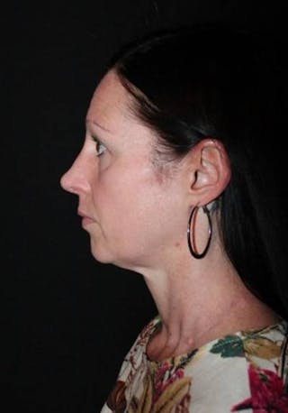 Rhinoplasty Before & After Gallery - Patient 408641 - Image 6
