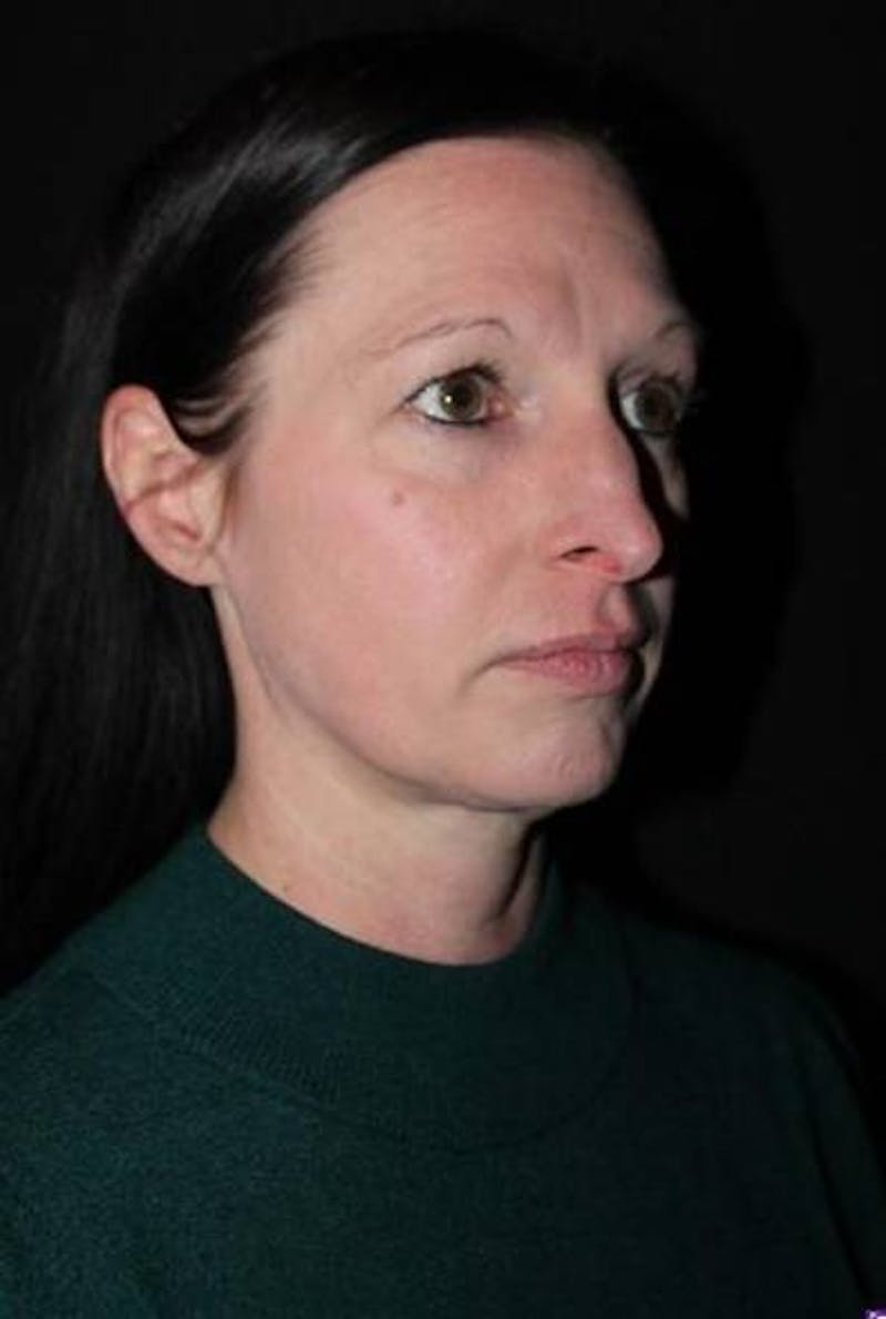 Rhinoplasty Before & After Gallery - Patient 408641 - Image 7