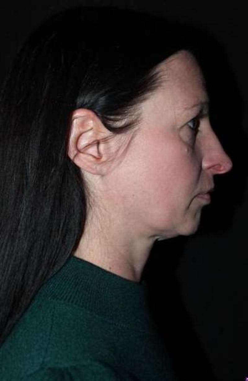 Rhinoplasty Before & After Gallery - Patient 408641 - Image 9
