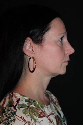 Rhinoplasty Before & After Gallery - Patient 408641 - Image 10