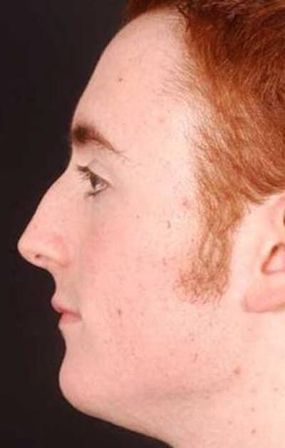 Rhinoplasty Before & After Gallery - Patient 524936 - Image 1