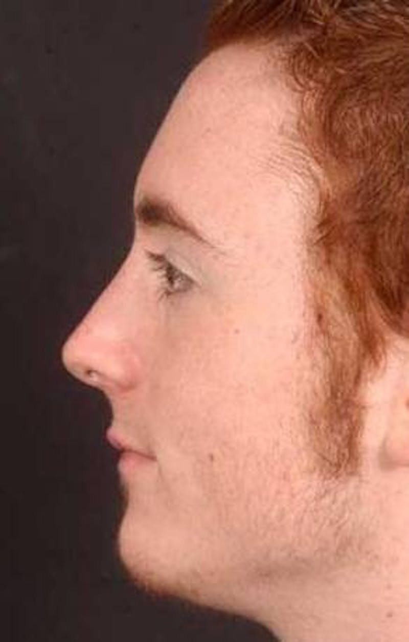 Rhinoplasty Before & After Gallery - Patient 524936 - Image 2
