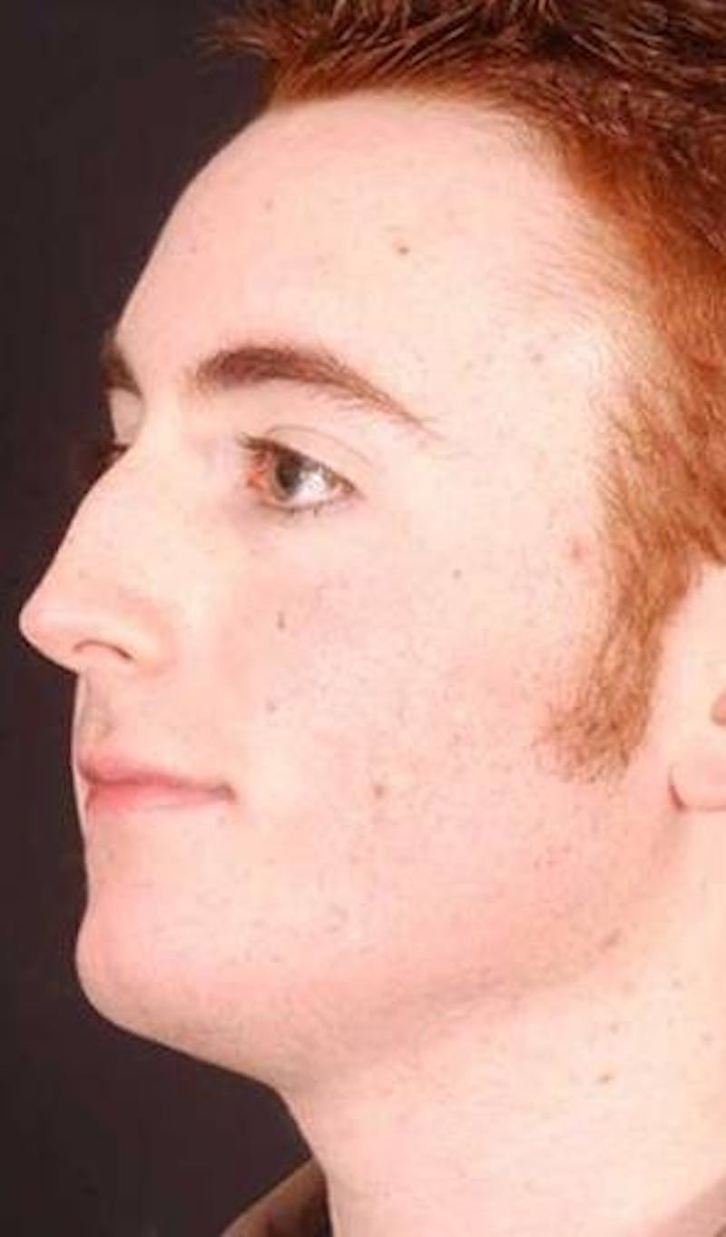 Rhinoplasty Before & After Gallery - Patient 524936 - Image 3