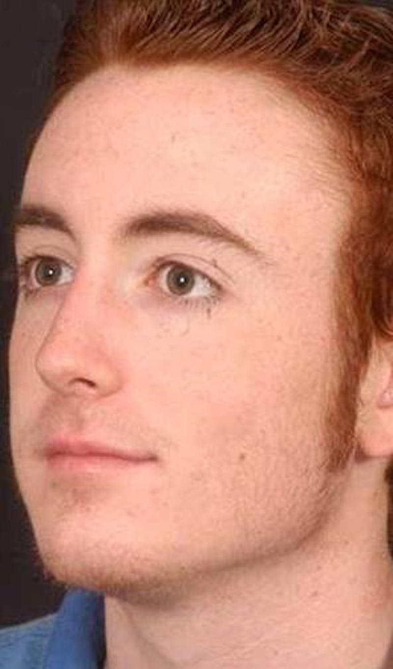 Rhinoplasty Before & After Gallery - Patient 524936 - Image 4