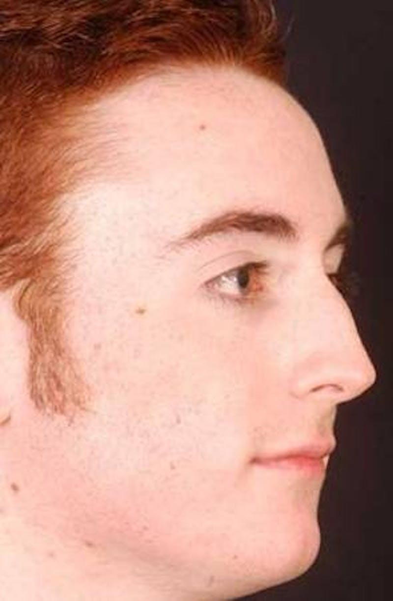 Rhinoplasty Before & After Gallery - Patient 524936 - Image 5