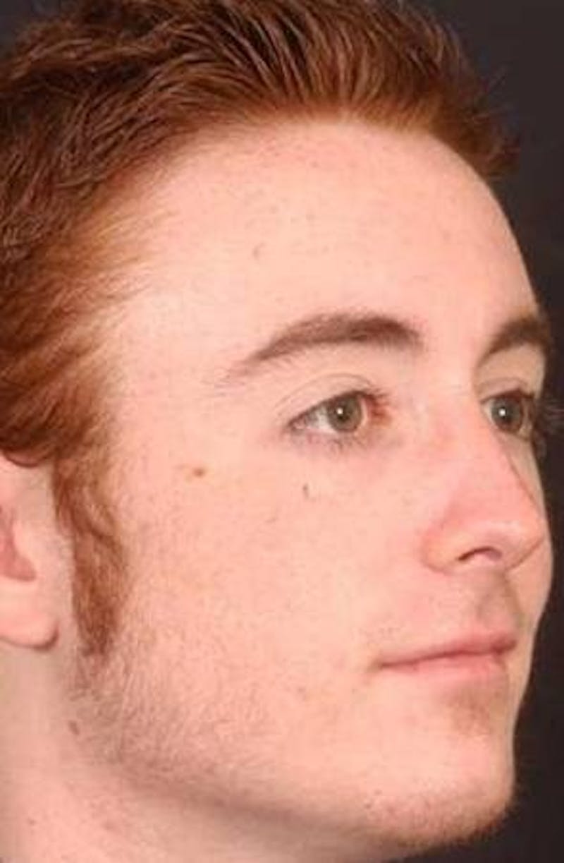 Rhinoplasty Before & After Gallery - Patient 524936 - Image 6