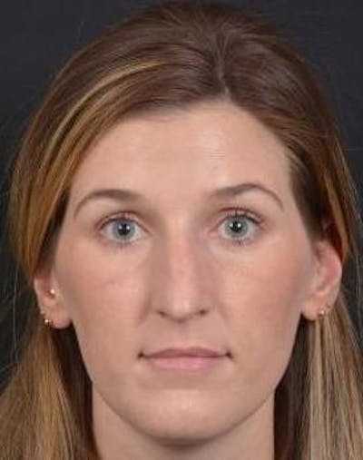 Rhinoplasty Before & After Gallery - Patient 251544 - Image 1