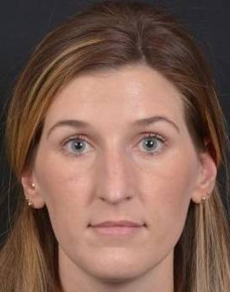 Rhinoplasty Before & After Gallery - Patient 251544 - Image 1