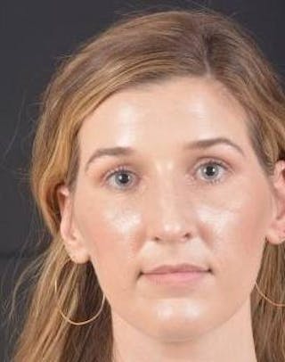 Rhinoplasty Before & After Gallery - Patient 251544 - Image 2