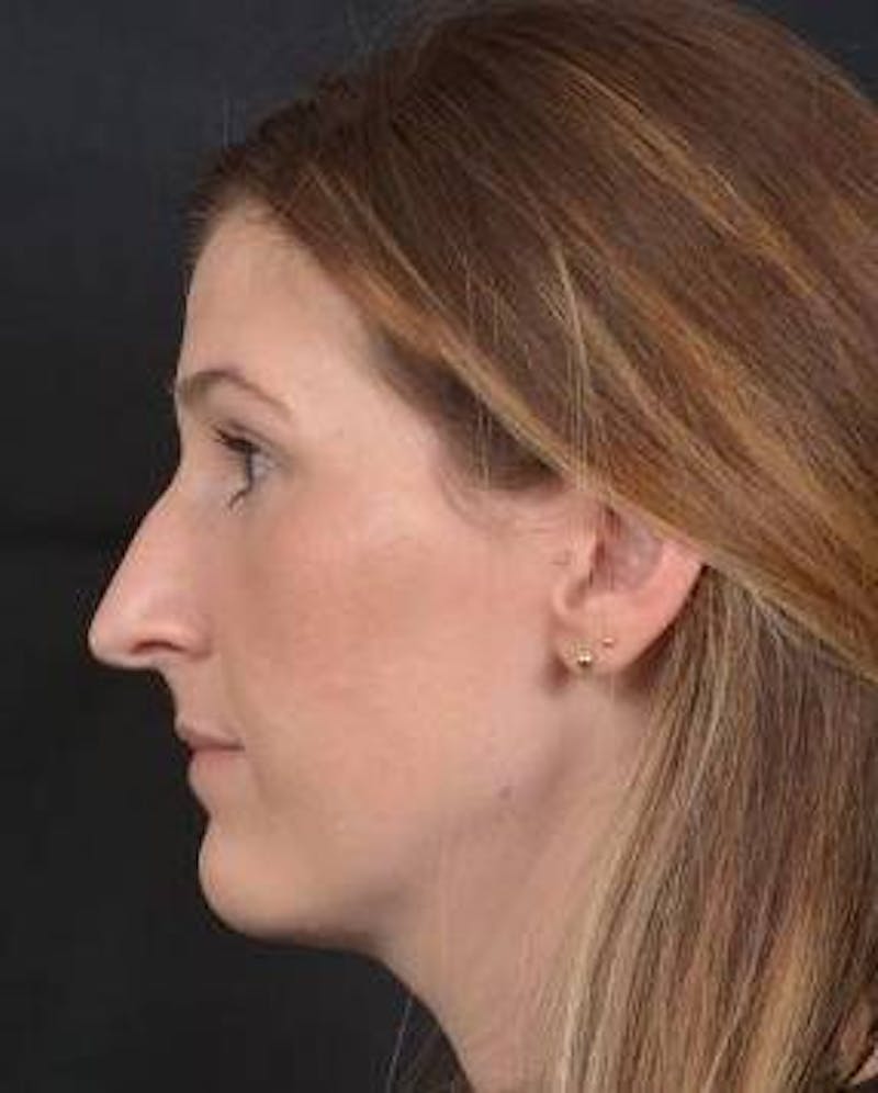 Rhinoplasty Before & After Gallery - Patient 251544 - Image 3